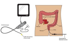 Immagine AL.MA.TEST: nuovo metodo diagnostico per la rilevazione precoce del cancro al colon-retto